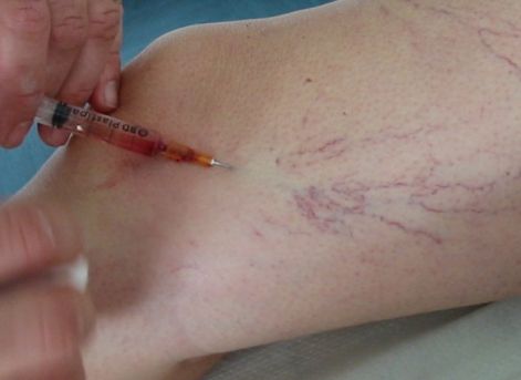 Seprűvénák, visszerek kezelési lehetőségei Visszér szkleroterápia fotó